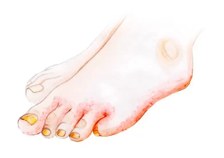 How to apply fungus and Zenidol cream on your toes