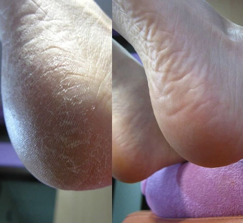 Image of the heel before and after using Zenidol cream