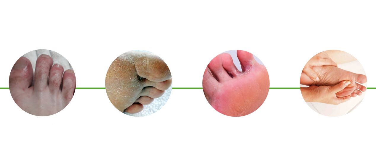 symptoms of foot fungus