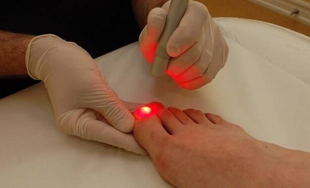 laser treatment of nail fungus