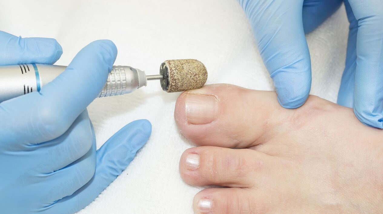 Apparatus treatment of fungus on toenails