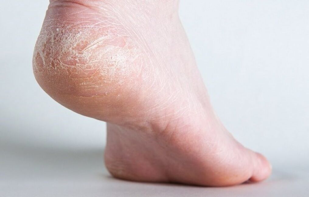 How to treat skin fungus on the feet