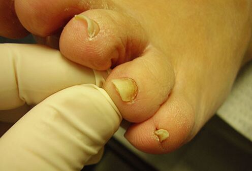 yellow toenails with fungus