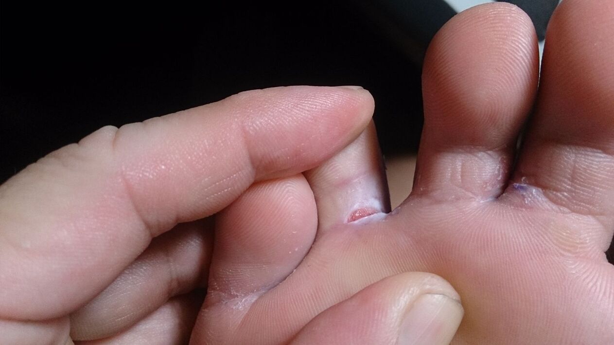 fungus between the toes