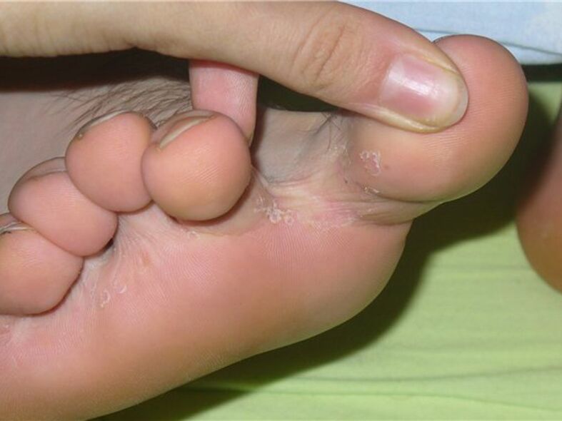 symptoms of finger fungus