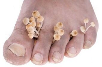 Fungus on feet