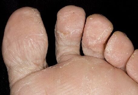 The initial stage of fungi, between the fingers