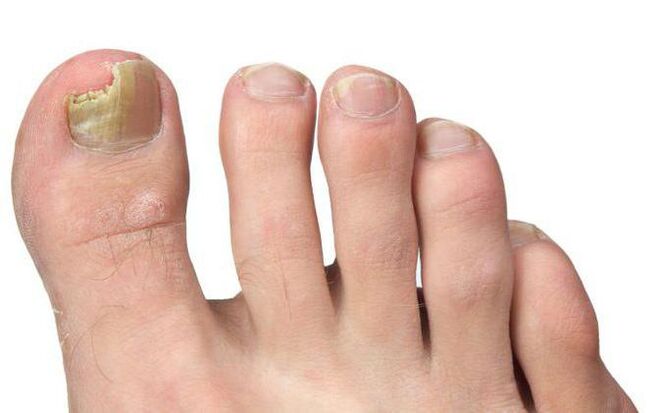 Mushrooms in the thumb of the foot
