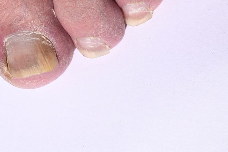 Initial stage of micosing of nails in feet
