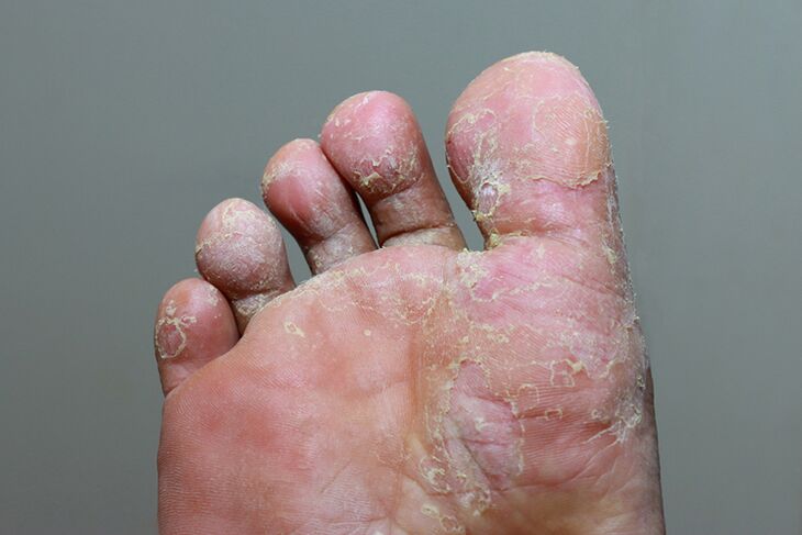 Severe phase of finger skin Micosure