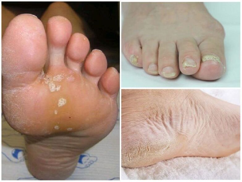 Symptoms of Mikson
