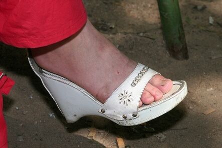 Dry skin in feet