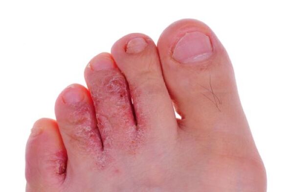 Fungal disease of the toes