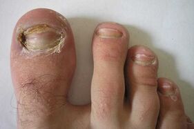 Damage to the nail plates on the toes due to a fungal infection
