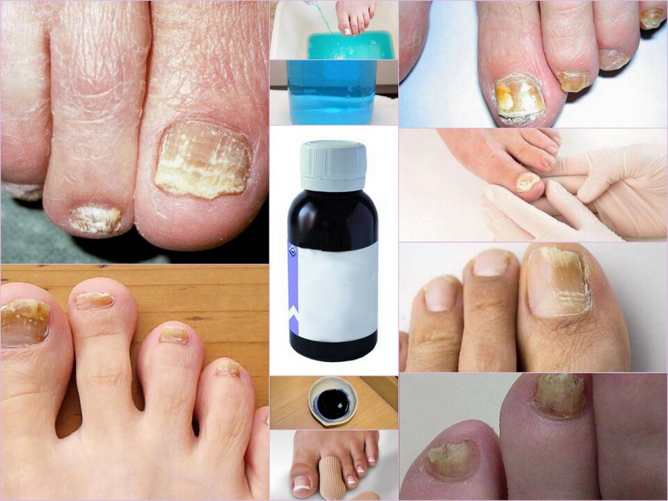 medications for nail fungus