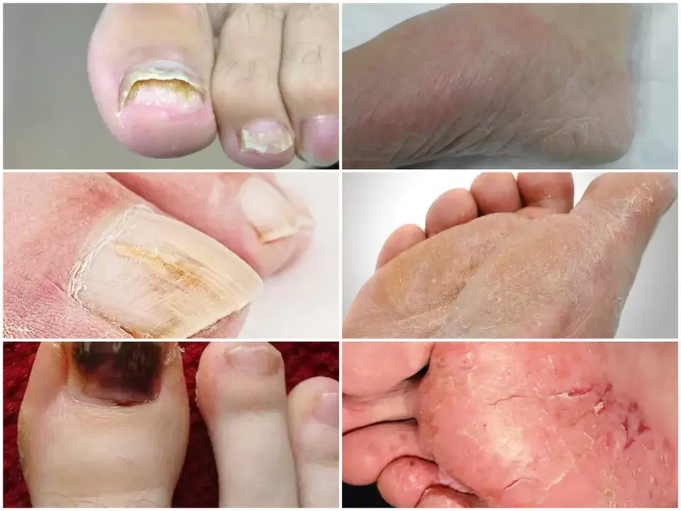 Manifestations of fungus on the feet from various pathogens
