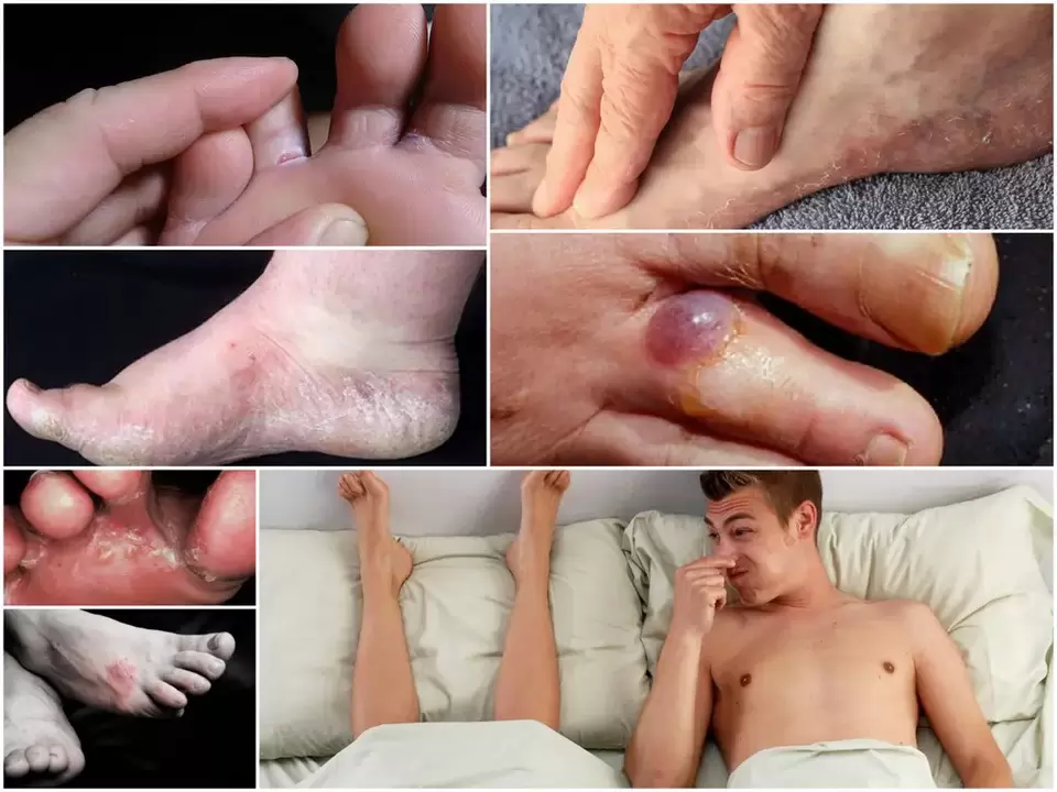 The main symptoms of foot fungus
