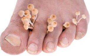 Onychomycosis of the nails