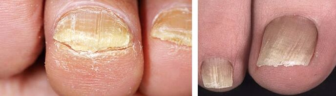 damage to nails with fungal infection