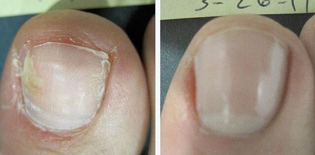 before and after treatment of nail fungus