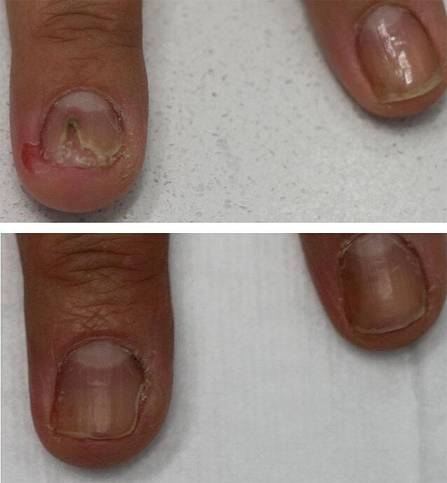 fungal infection of the nails