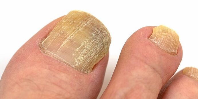 Damage to nails with advanced fungal infection