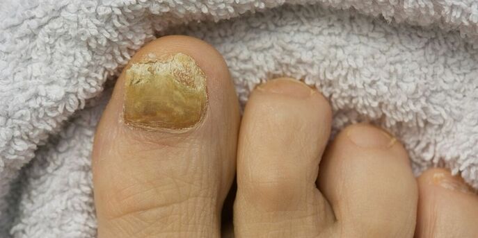 yellow nail with fungal infection