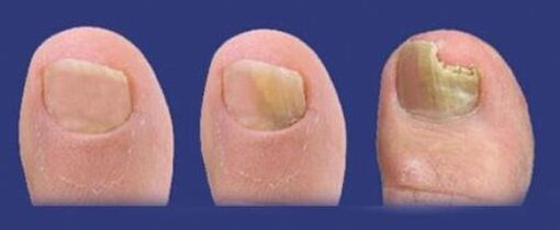 stages of fungal development on toenails