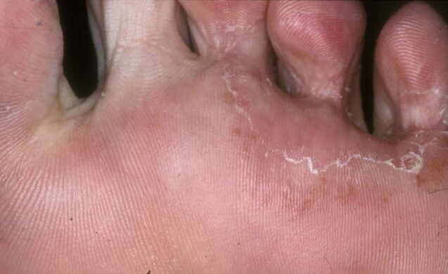 foot affected by trichophyton rubrum fungus