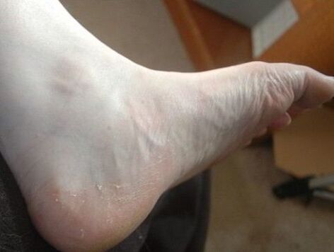 peeling of the foot of the foot as a sign of fungal infection