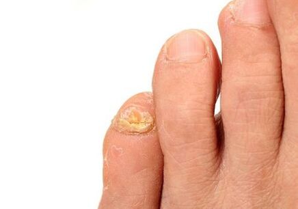 nail affected by fungal dermatophytes