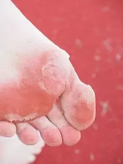 symptoms of athlete's foot